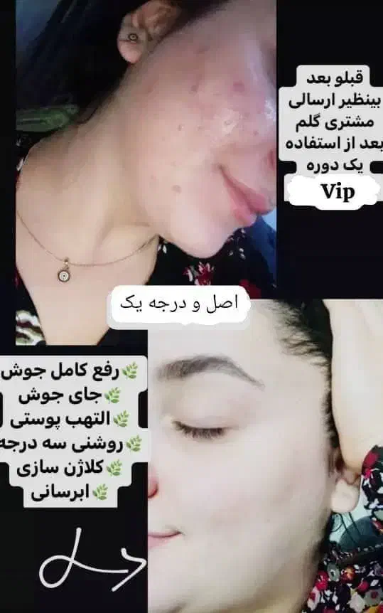 کرم vip بزرگ ضدلک و سفید کننده|آرایشی، بهداشتی، درمانی|گرگان, |دیوار