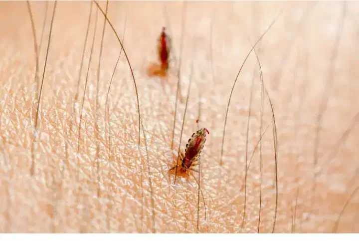 مایع رفع شپش مو|آرایشی، بهداشتی، درمانی|کرج, شهر صنعتی|دیوار