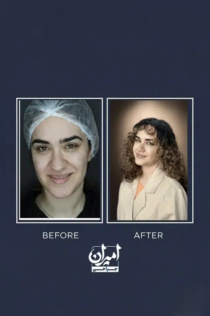 عمل بینی/جراحی بینی|خدمات آرایشگری و زیبایی|لار, |دیوار