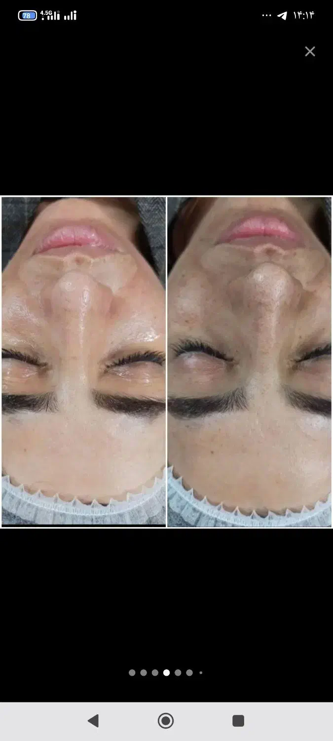 تخفیفات جشنواره فشیال و پاکسازی تخصصی پوست|خدمات آرایشگری و زیبایی|اصفهان, الهیه|دیوار