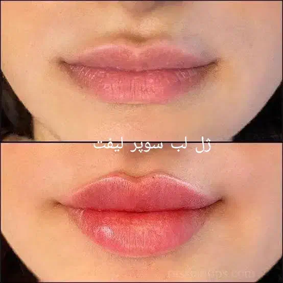 تخفیف ۵۰درصدی تزریق ژل چربی بوتاکس و جراحی زنان|خدمات آرایشگری و زیبایی|رشت, گلسار|دیوار