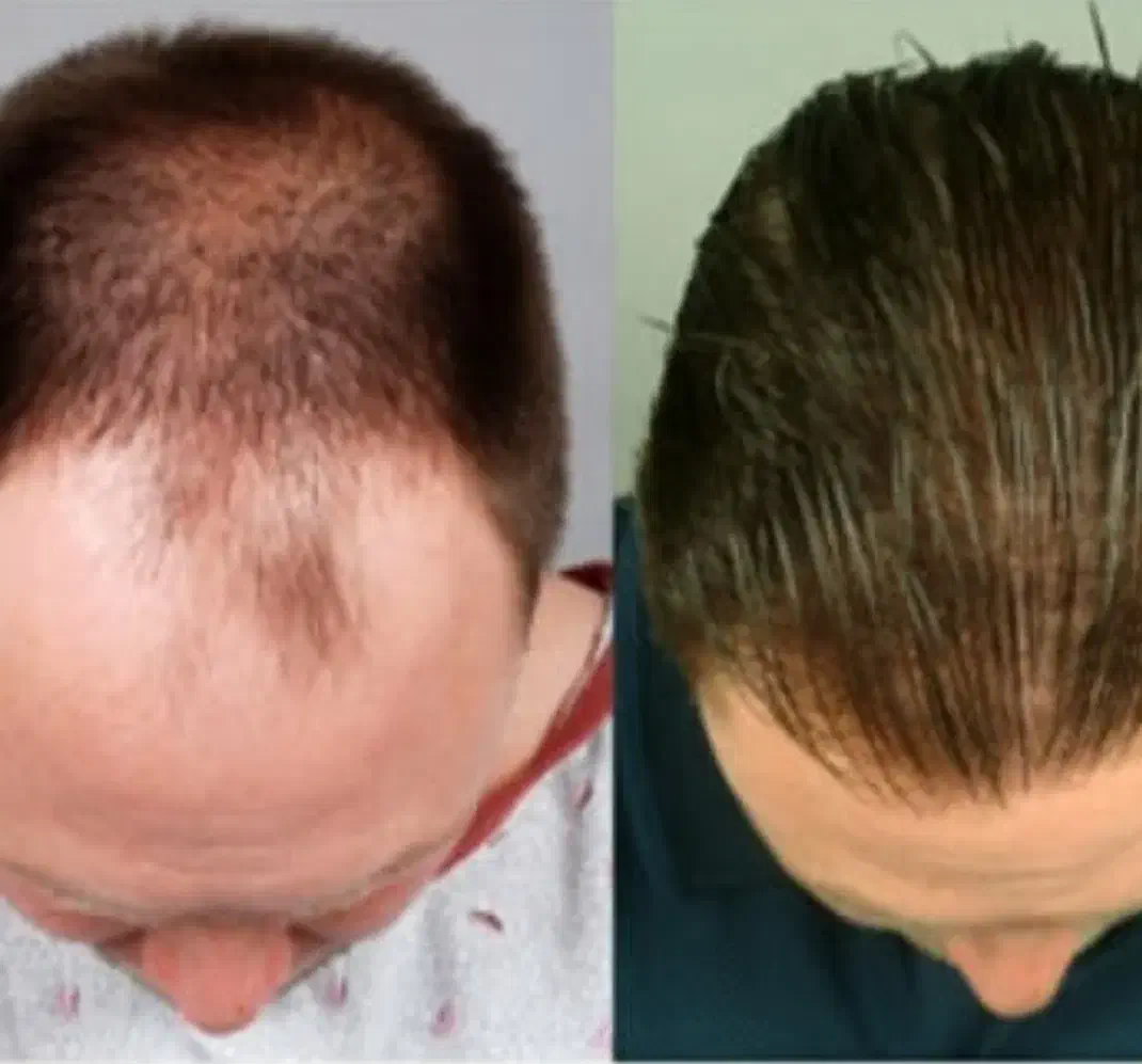 پروتز مو|آرایشی، بهداشتی، درمانی|اهواز, اهواز|دیوار