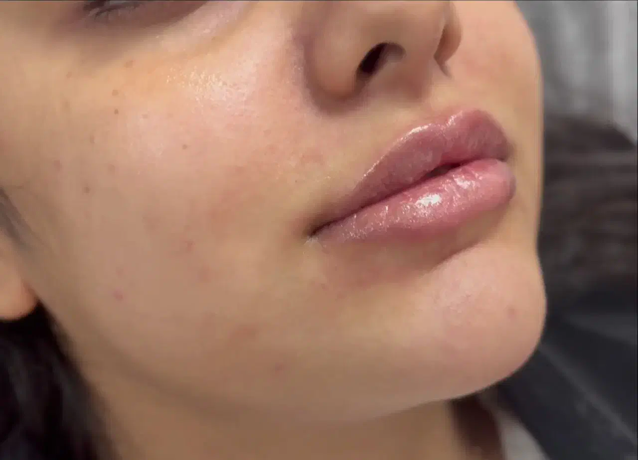 تزریق ژل لب تکنیک Mوبوتاکس|خدمات آرایشگری و زیبایی|تهران, شهرک ولیعصر جنوبی|دیوار