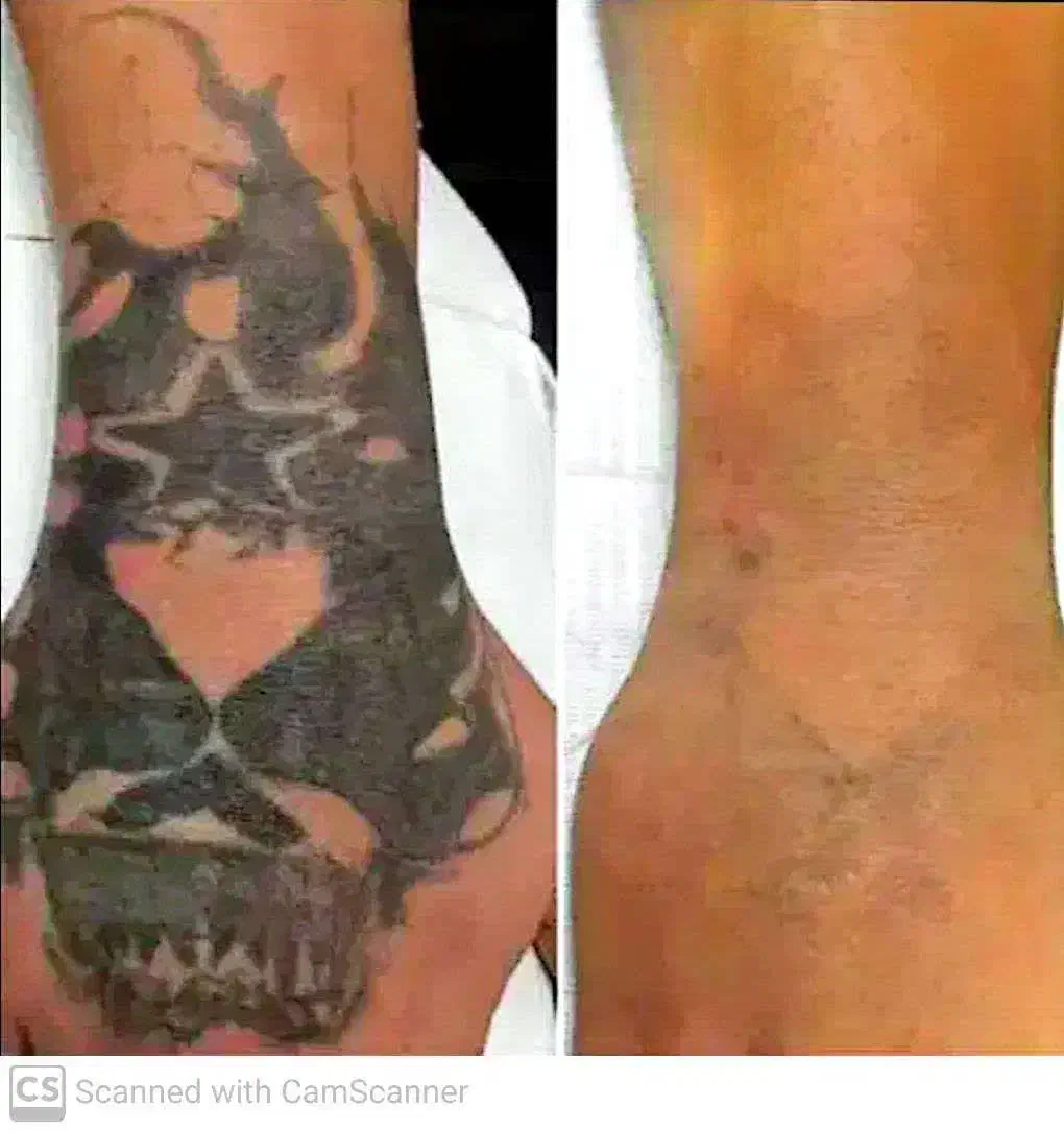 پاک کردن تتو کربن پیل و درمان لک با لیزر کیوسوییچ|خدمات آرایشگری و زیبایی|قم, چهل درخت|دیوار