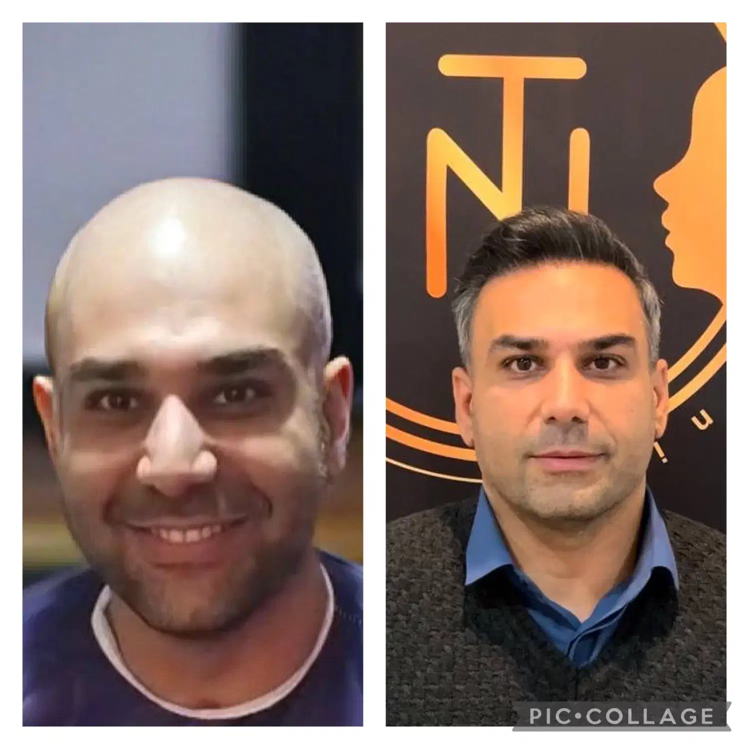 کاشت مو و ابرو با ضمانتنامه کتبی با ۸ ملیون تومان|خدمات آرایشگری و زیبایی|تهران, پاسداران|دیوار