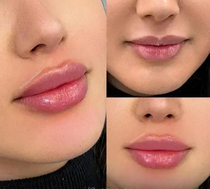 تزریق ژل بوتاکس لیفت مادلینگ و کانتورینگ کلینیک|خدمات آرایشگری و زیبایی|بندرعباس, |دیوار