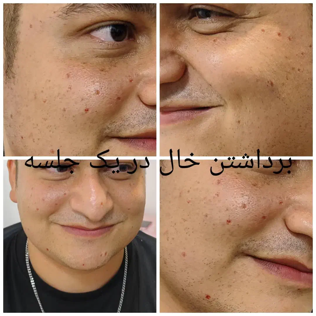 برداشتن خال کک مک منگوله گوشتی لک در یک جلسه ژل|خدمات آرایشگری و زیبایی|گلستان (تهران), |دیوار