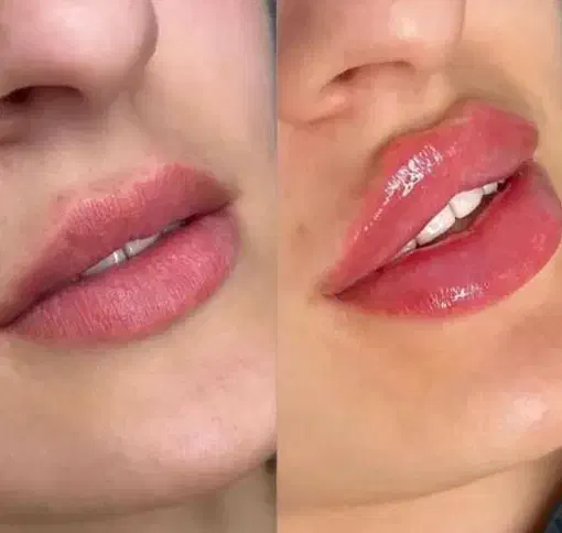 فیلرلب روسی ،گونه و زاویه،بوتاکس، فول فیس،زیرچشم|خدمات آرایشگری و زیبایی|شیراز, ستارخان|دیوار