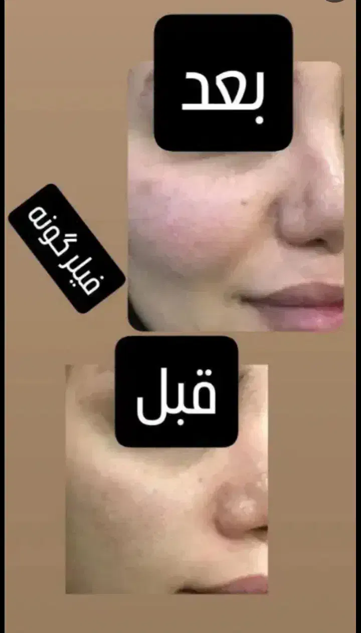 ژل لب گونه چونه زاویه مادلینگ راویه سازی|خدمات آرایشگری و زیبایی|قم, تولید دارو و یخچال|دیوار