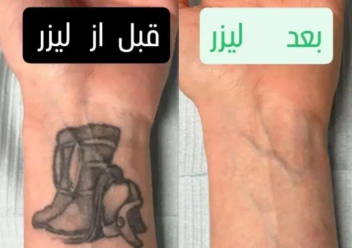 پاک کردن تتو با پیشرفته ترین لیزر کیوسوئیچ|خدمات آرایشگری و زیبایی|اهواز, کوی سعدی|دیوار