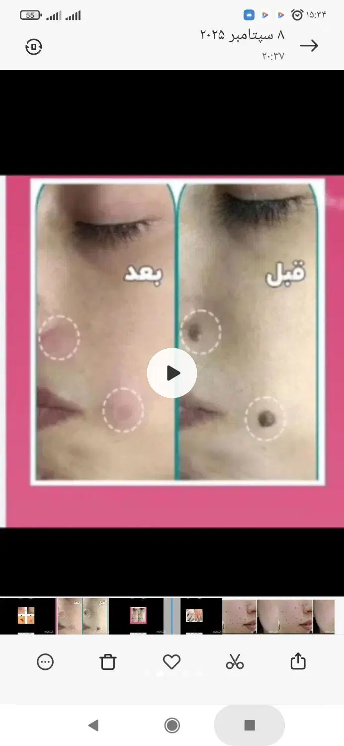 لیزرخال وزگیل منگوله های گوشتی بدون درد|پزشکی|دورود, |دیوار