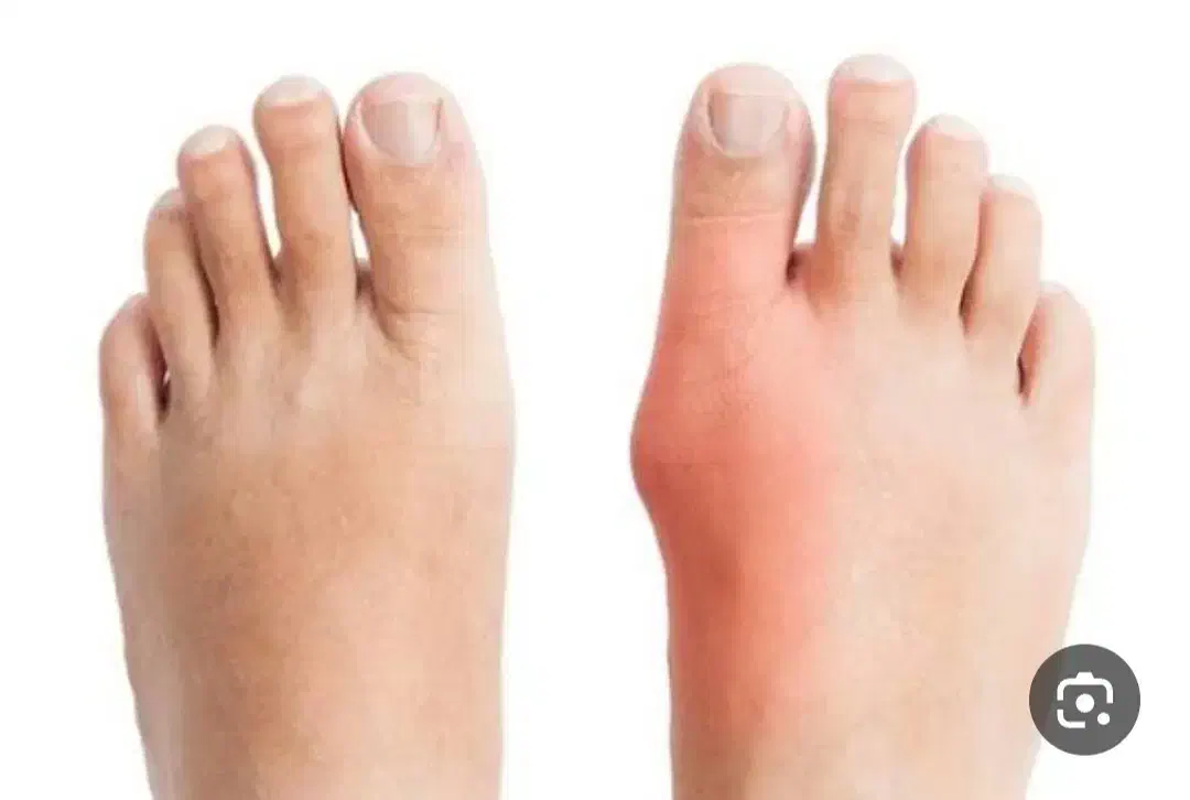 کلینیک درمان هالوکس والگوس (شصت پای کج)|خدمات آرایشگری و زیبایی|بهار, |دیوار