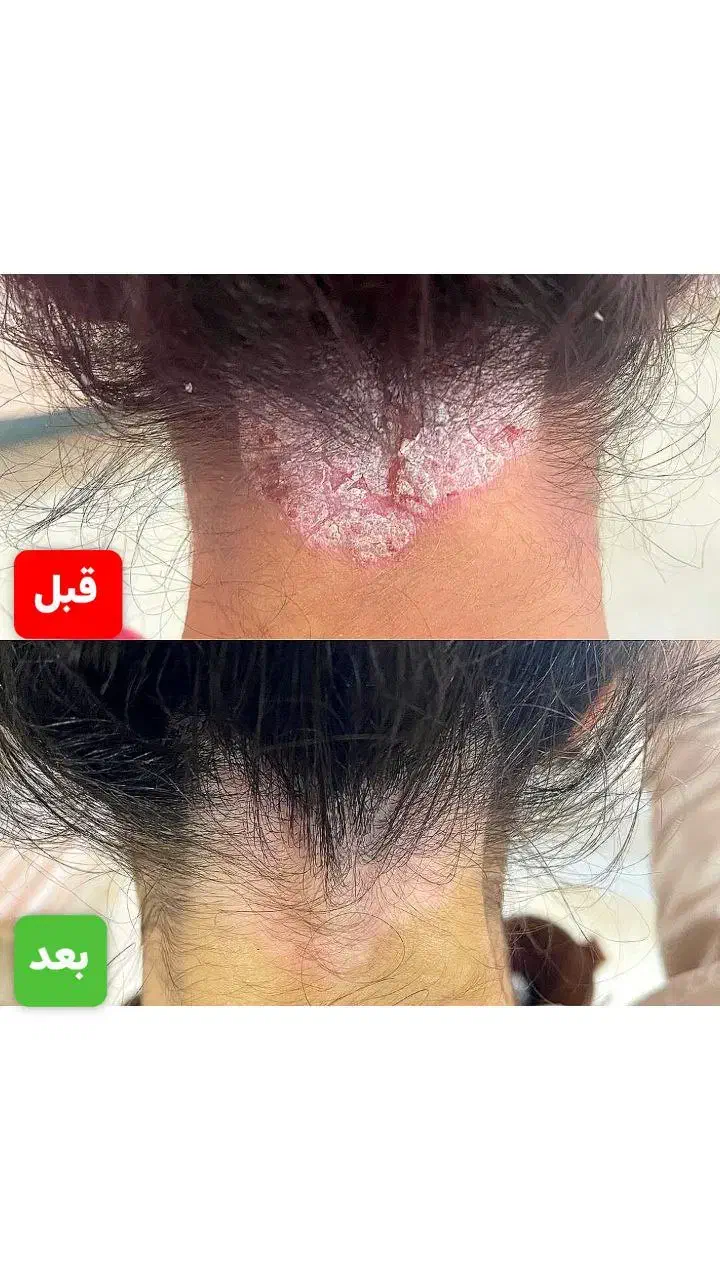 درمان وبدون برگشت بیماری های پیسی وپسوریازیس|خدمات آرایشگری و زیبایی|قم, آرامستان بهشت معصومه|دیوار