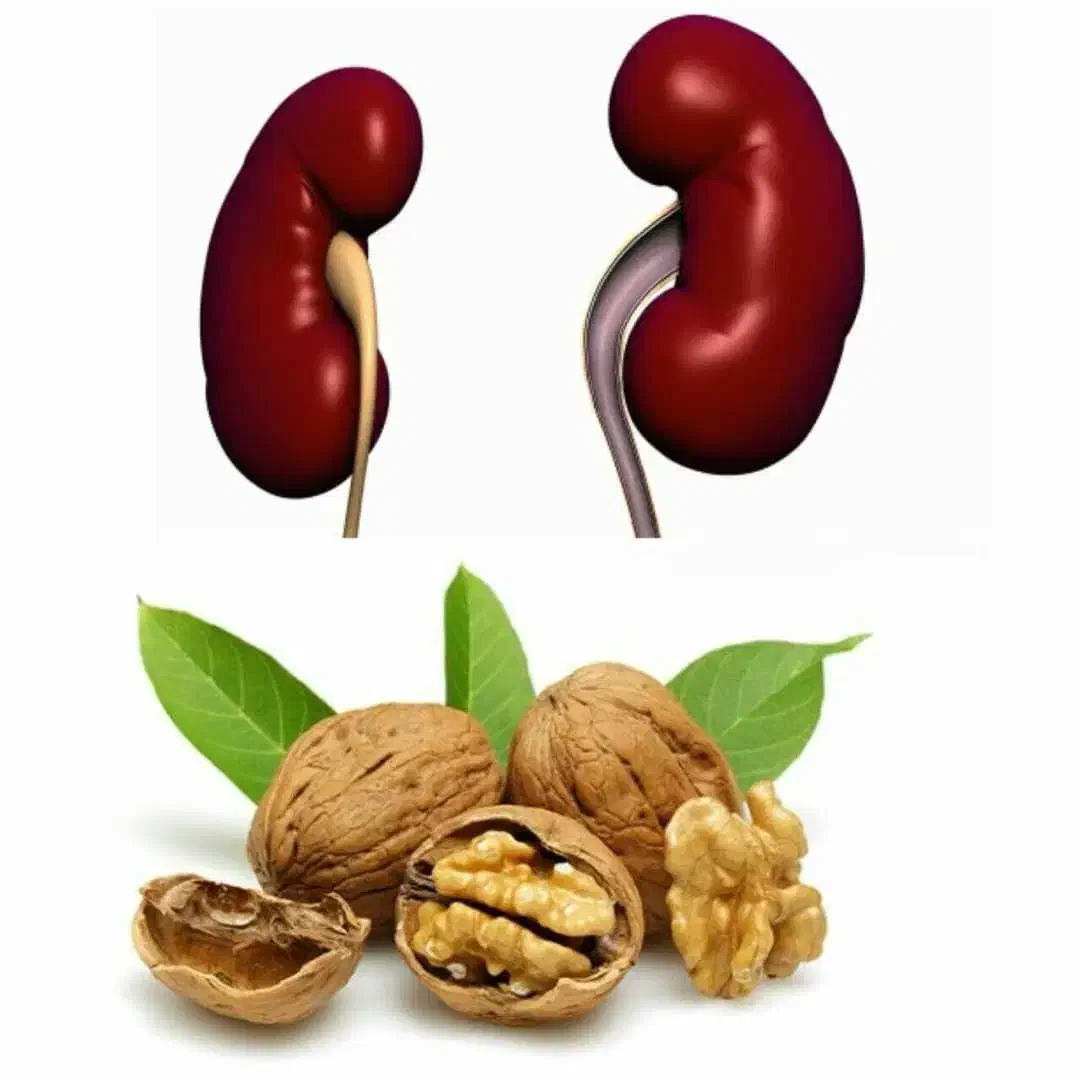 رفع سنگ کلیه|خوردنی و آشامیدنی|میناب, |دیوار