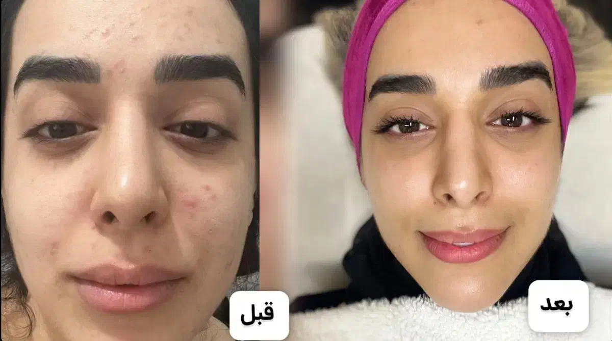 پاکسازی،فیشال درمان مشکلات پوستی|خدمات آرایشگری و زیبایی|زابل, |دیوار