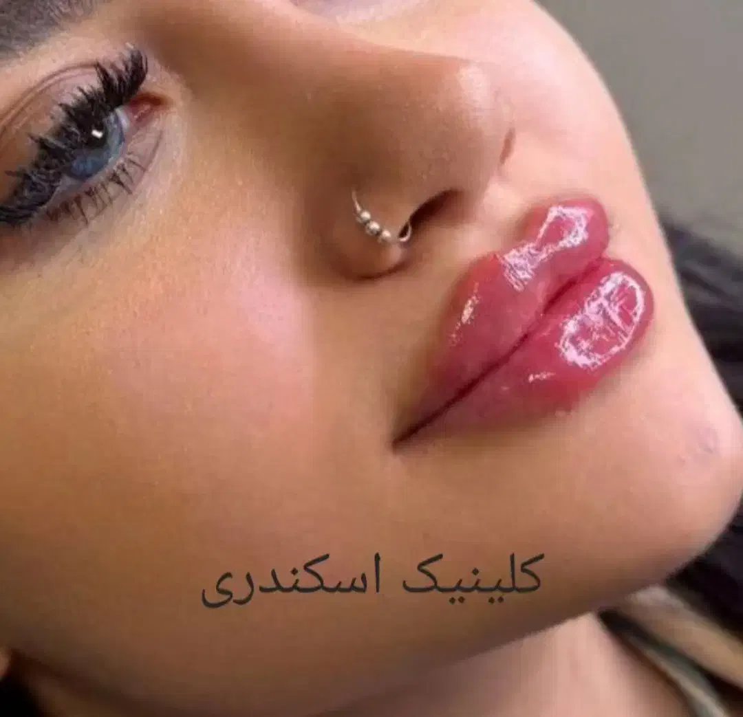 آف ویژه یلدامجتمع پزشکی اسکندری تزریق ژل فیلر ...|خدمات آرایشگری و زیبایی|تهران, نیروی هوایی (پیروزی)|دیوار