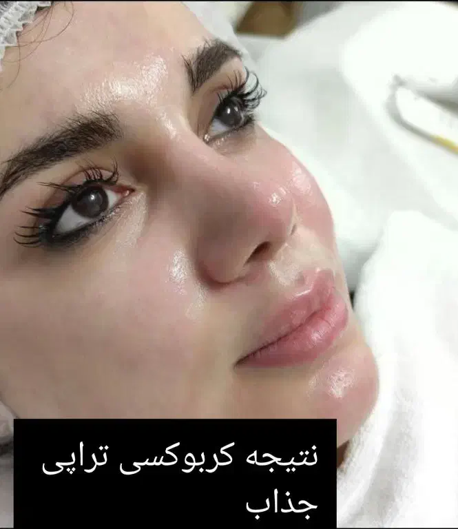 فیشیال صورت آقایان وخانم ها مطب دکتر پروین گودرزی|خدمات آرایشگری و زیبایی|یاسوج, |دیوار