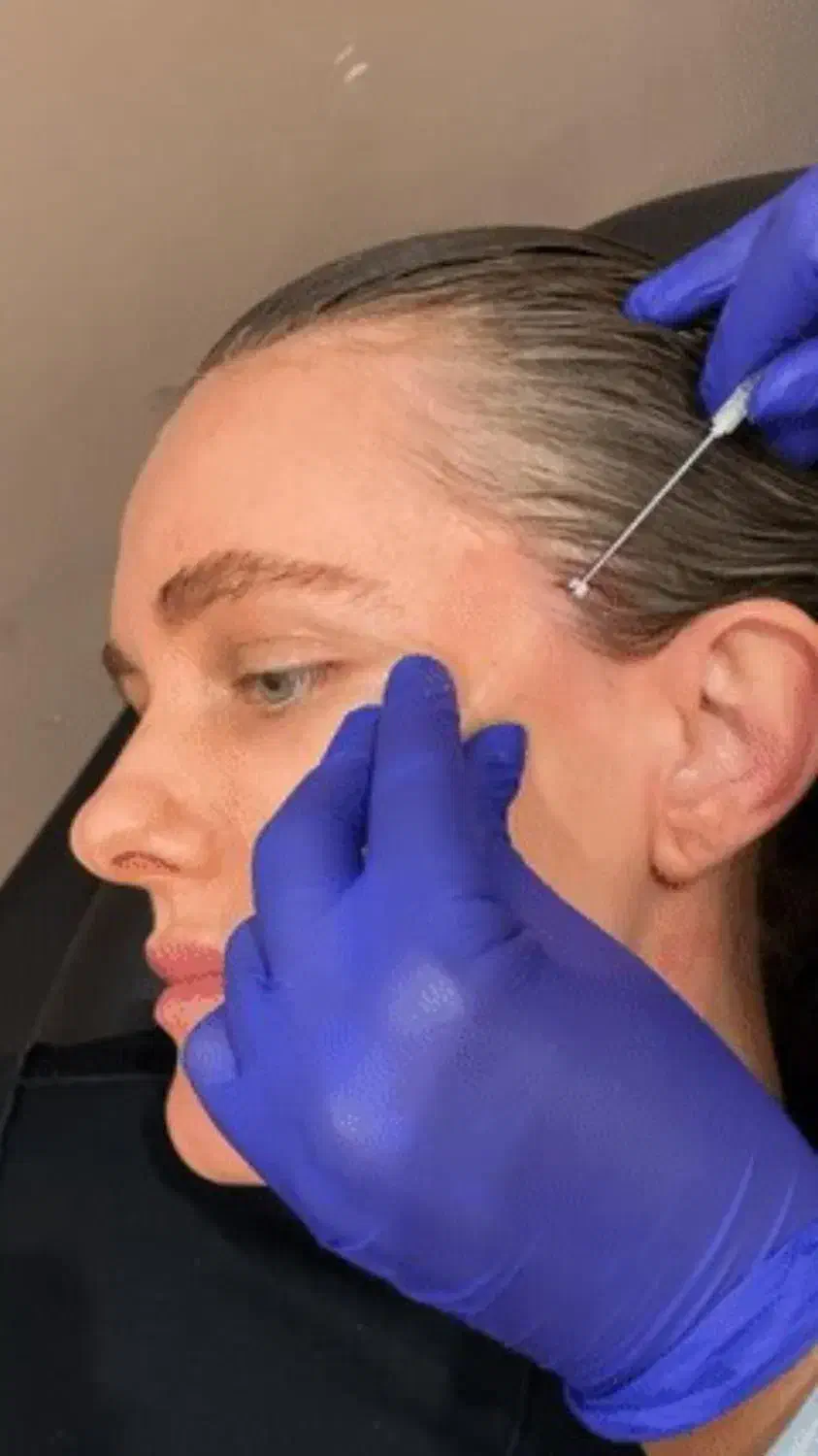 بوتاکس ژل مزوتراپی مو و صورت میکرونیدلینگ فشیال|خدمات آرایشگری و زیبایی|چهارباغ, |دیوار