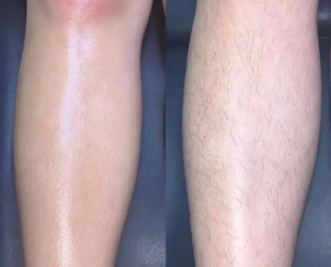 تخفیف به مدت یک هفته(پاکسازی پوست،اپلاسیون،لیفت)|خدمات آرایشگری و زیبایی|گالیکش, |دیوار