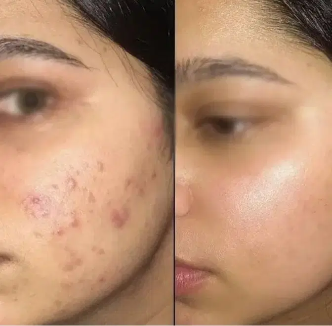 پاکسازی سوپرفشیال تخصصی، مطب ویژه آقایان وبانوان|خدمات زیبایی و سلامت|تهران, نارمک|دیوار