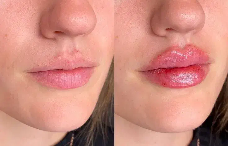 تخفیف تزریق ژل، بوتاکس در منزل|خدمات آرایشگری و زیبایی|گرگان, |دیوار