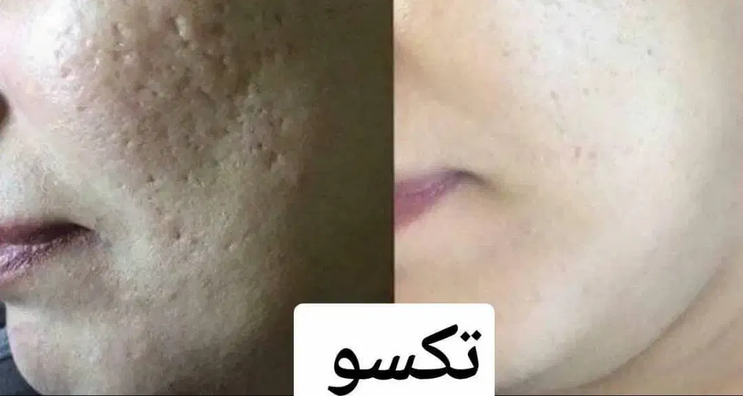 پوست ومو|آرایشی، بهداشتی، درمانی|قم, قم نو|دیوار