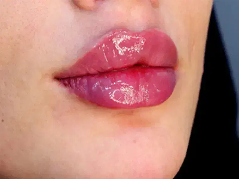 ژل، بوتاکس،لیزر،پی ارپی|خدمات آرایشگری و زیبایی|سیرجان, |دیوار