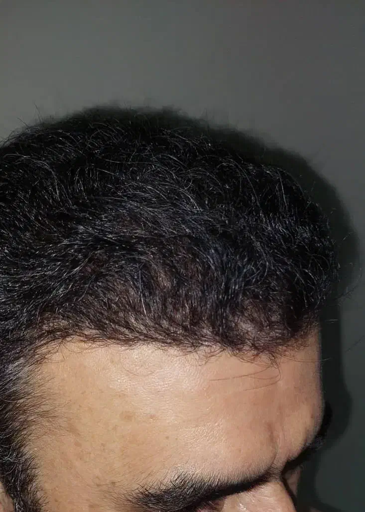 کاشت مو و ابرو با جدید ترین دستگاه های روز دنیا|خدمات آرایشگری و زیبایی|یاسوج, |دیوار