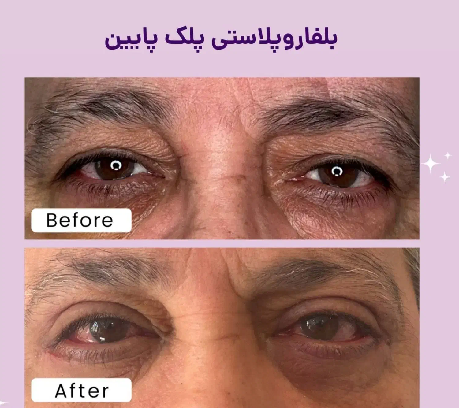 عمل زیبائی پلک پائین شامل پف ، چروک و...|خدمات آرایشگری و زیبایی|اصفهان, خلجا|دیوار