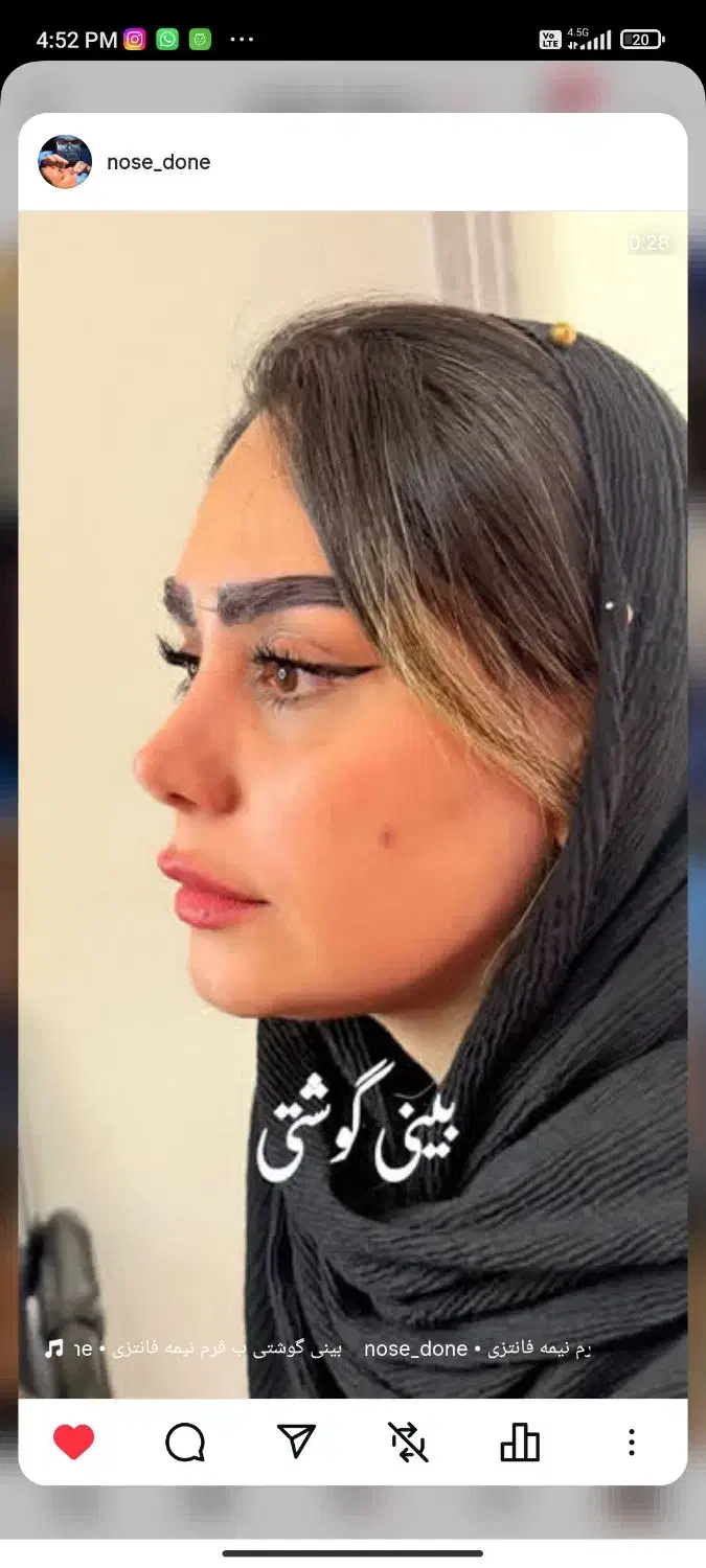 جراحی بینی ۲۹ میلیون فقط ۸ اذر|خدمات آرایشگری و زیبایی|قم, بکایی|دیوار