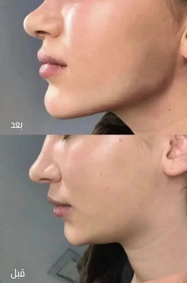 خدمات تزریق تخصصی ژل ،فیلر و بوتاکس و آنزیم|خدمات آرایشگری و زیبایی|سبزوار, جنت|دیوار
