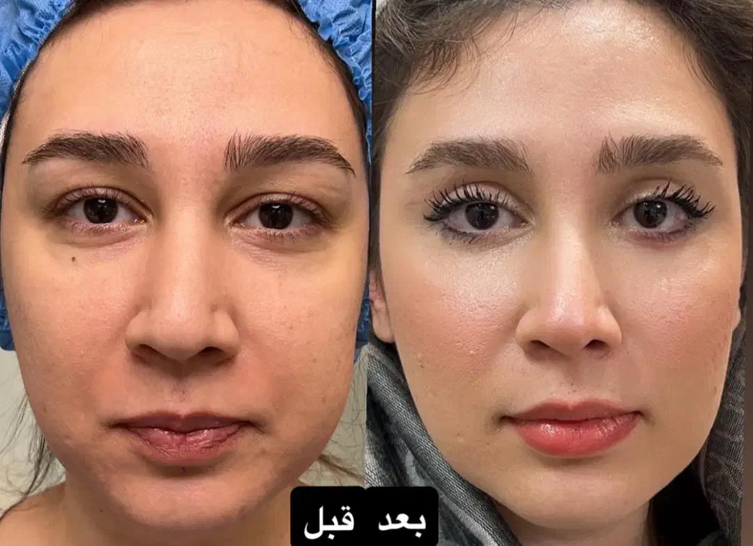 بلفاروپلاستی پلک|خدمات آرایشگری و زیبایی|تهران, یوسف‌آباد|دیوار