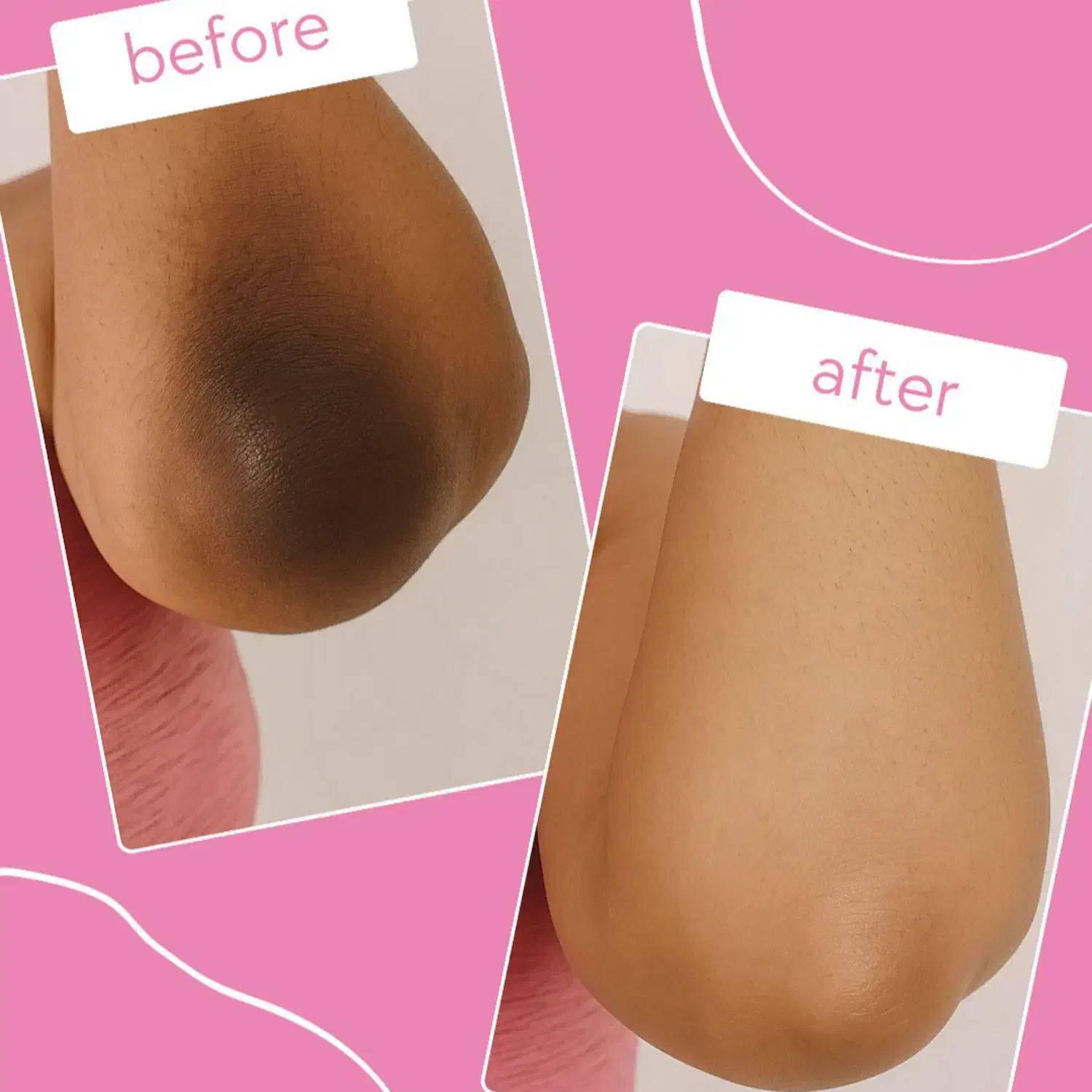 درمان دائمی تیرگی بدن ( بدون لیزر )|خدمات آرایشگری و زیبایی|ساری, |دیوار