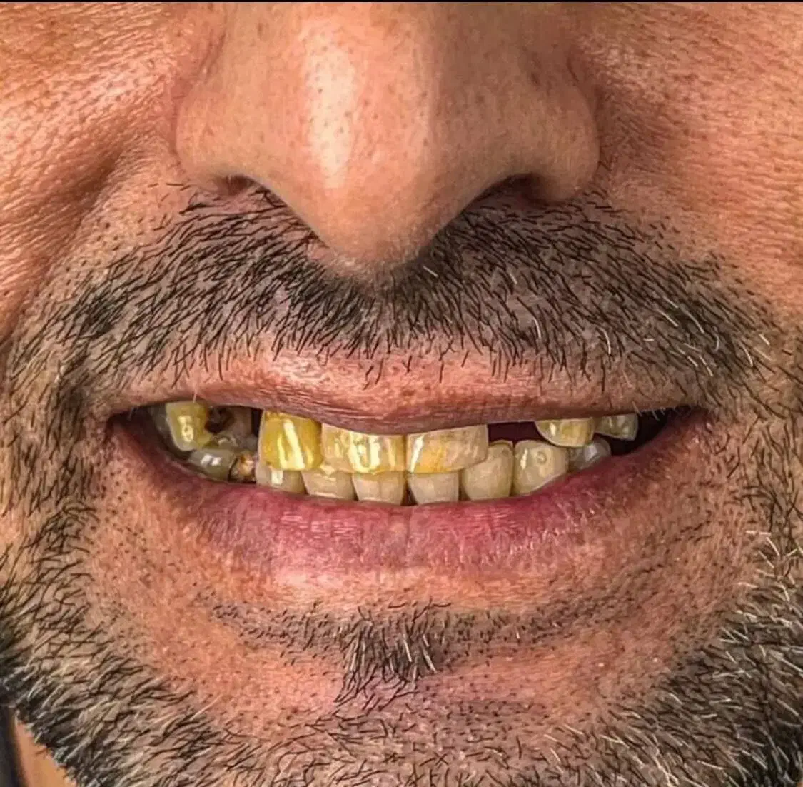 تخفیف ایمپلنت   شرایط ویژه دندانپزشکی|خدمات آرایشگری و زیبایی|اسکو, |دیوار