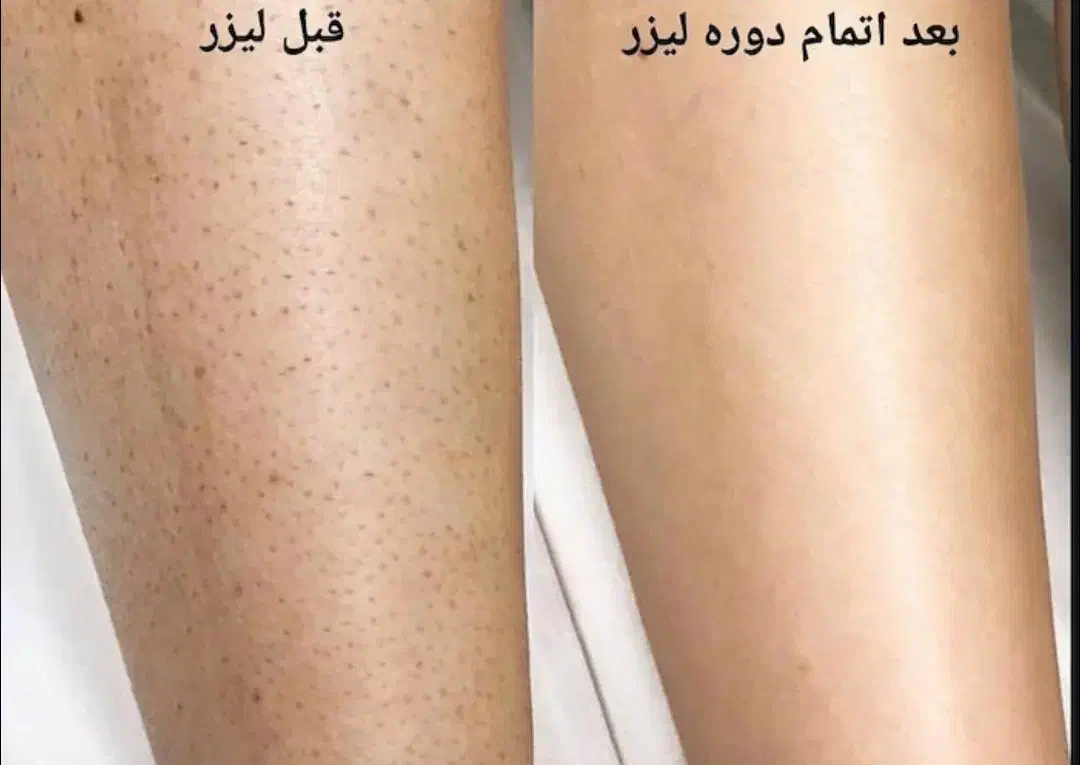 لیزر مو های زائد باکیفیت بالا هزینه پایین|استخدام درمانی، زیبایی، بهداشتی|اهواز, کمپلو جنوبی|دیوار