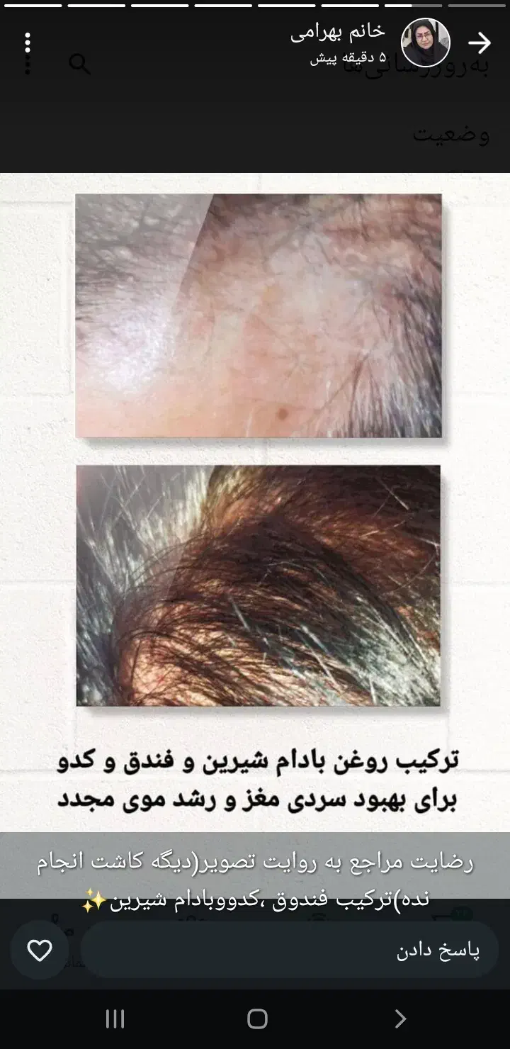 ریزش مومجدد|آرایشی، بهداشتی، درمانی|رامشیر, |دیوار