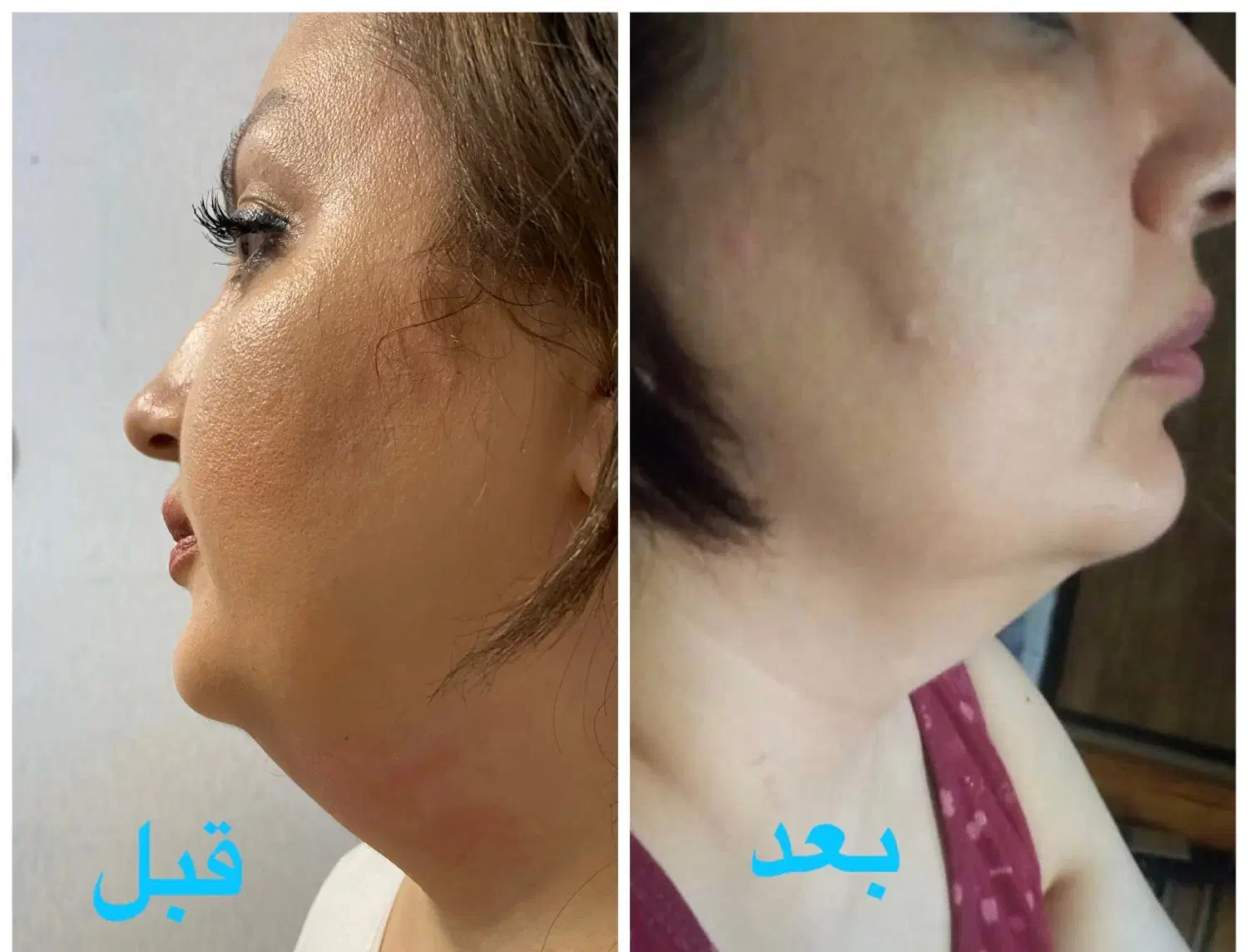 تخفیف استثنایی هایفوصورت،واژینال،کک،مک،درمان تیرگی|خدمات آرایشگری و زیبایی|تهران, هاشمی|دیوار
