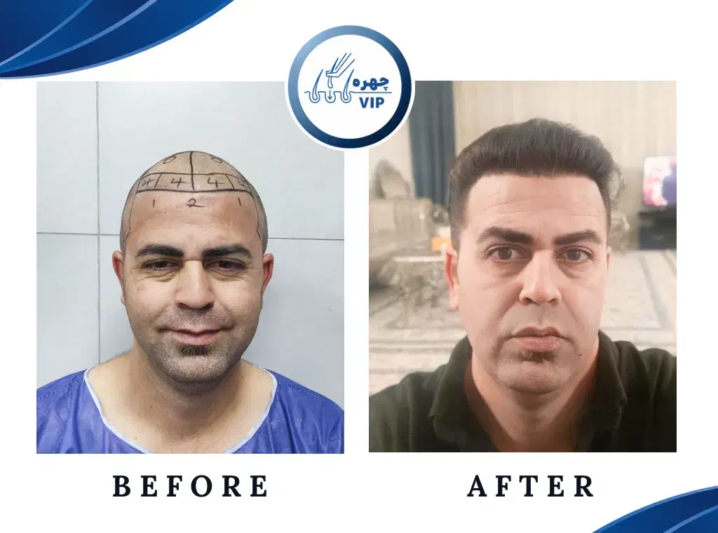 کاشت مو پرتراکم|خدمات آرایشگری و زیبایی|تهران, ونک|دیوار