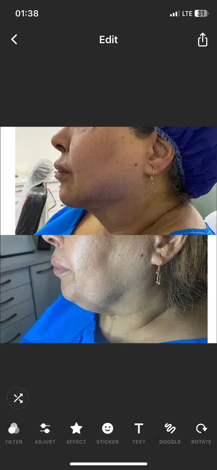 ساکشن غبغب و شکم فیلر بادی پی ار پی ژل و بوتاکس|خدمات آرایشگری و زیبایی|شیراز, قصرالدشت|دیوار