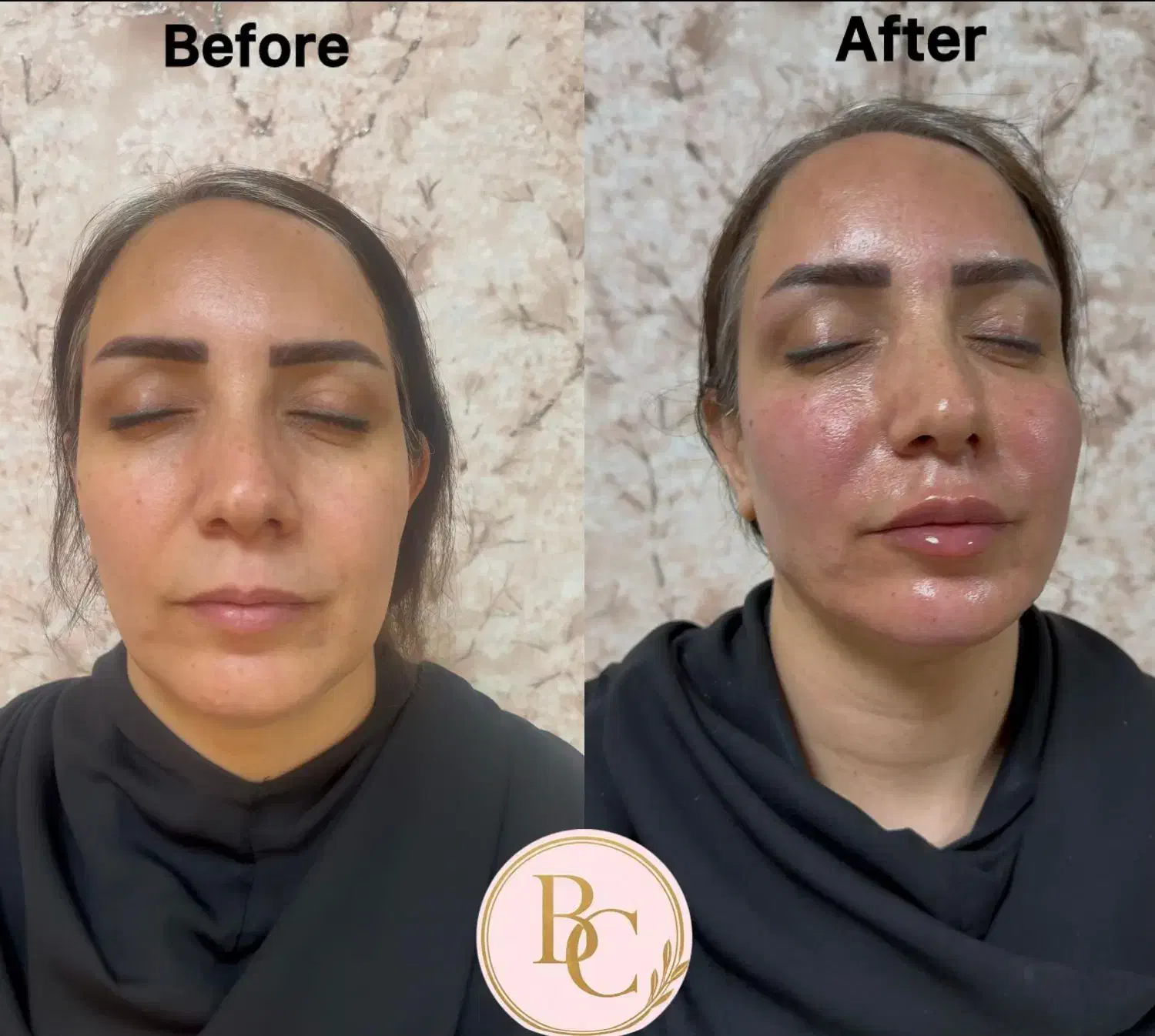 تزریق فیلر لب بادی بوتاکس فول فیس بلفارو غبغب|خدمات آرایشگری و زیبایی|تهران, نیاوران|دیوار