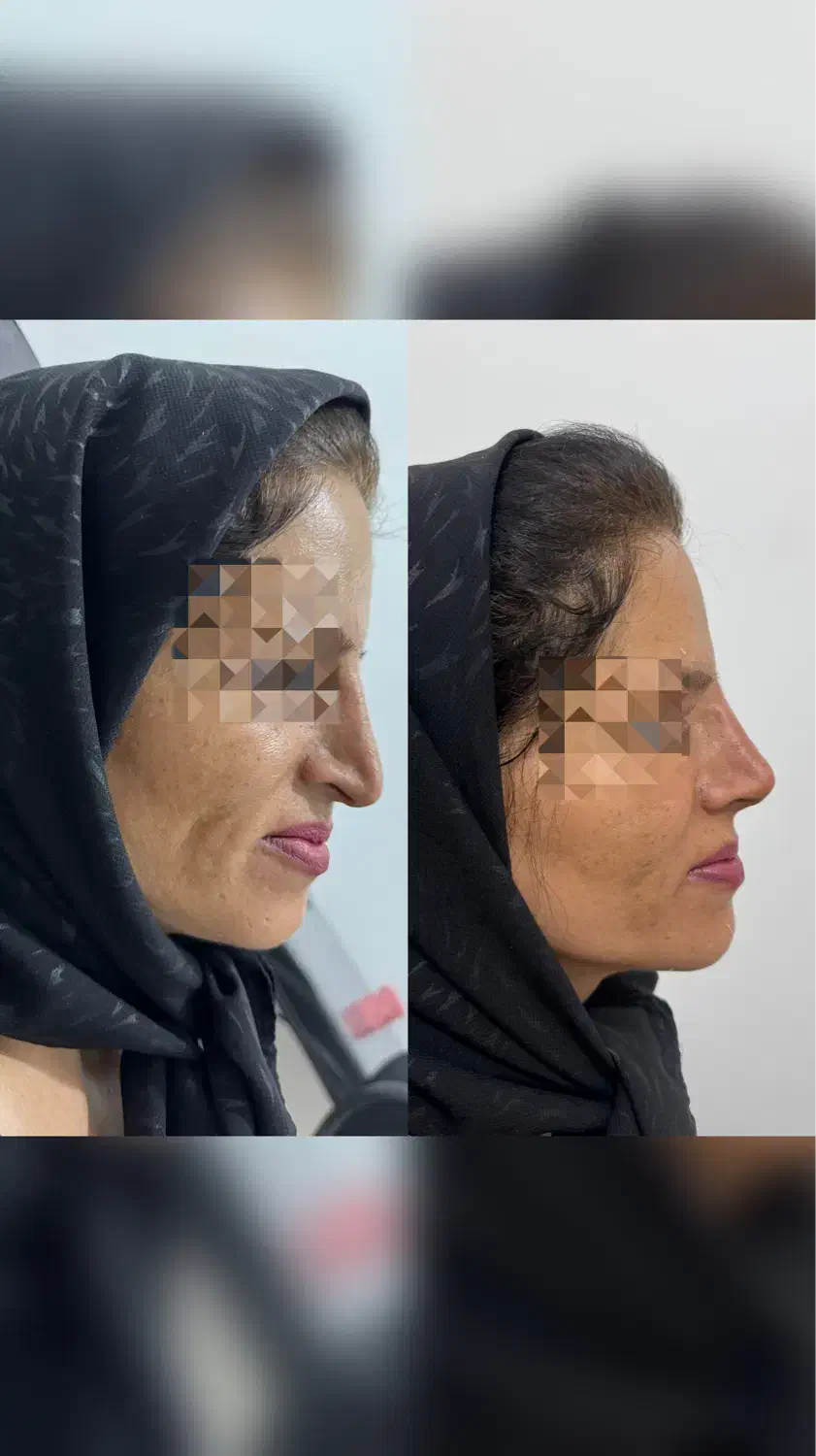 مرکزتخصصی لیفت بانخ و کانتورینگ صورت|خدمات آرایشگری و زیبایی|کرمانشاه, |دیوار