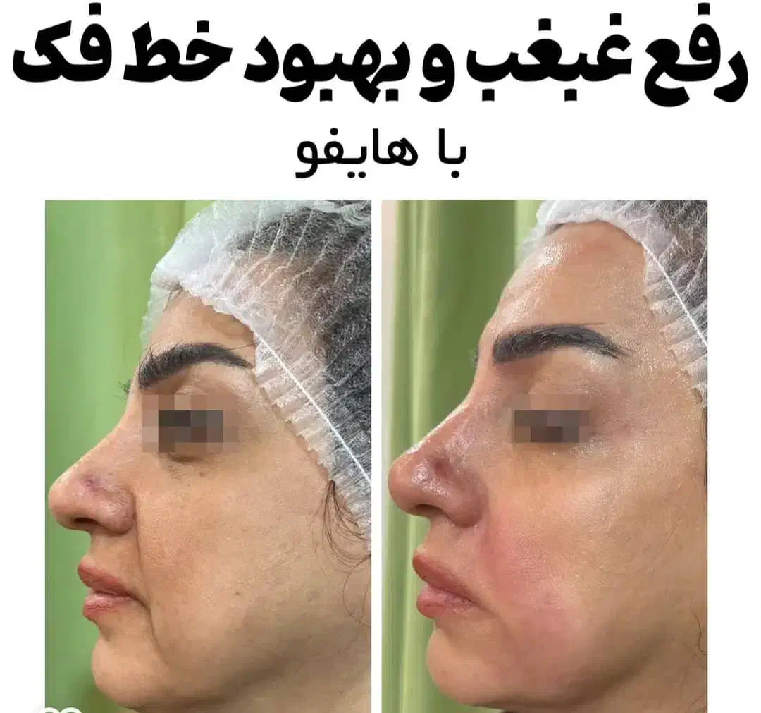 هایفوتراپی رفع چین و چروک پوست با بروزترین تجهیزات|خدمات آرایشگری و زیبایی|شیراز, قدوسی غربی|دیوار