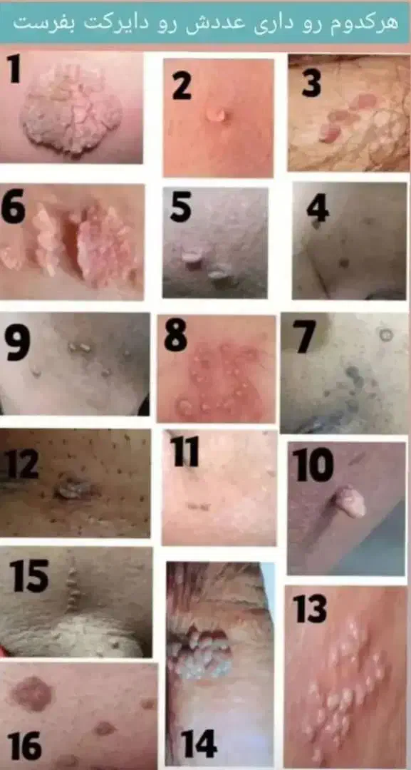 حذف وریشه کن شدن زگیل تناسلی بامحلول گیاهی|خدمات آرایشگری و زیبایی|اصفهان, بوستان ناژوان|دیوار