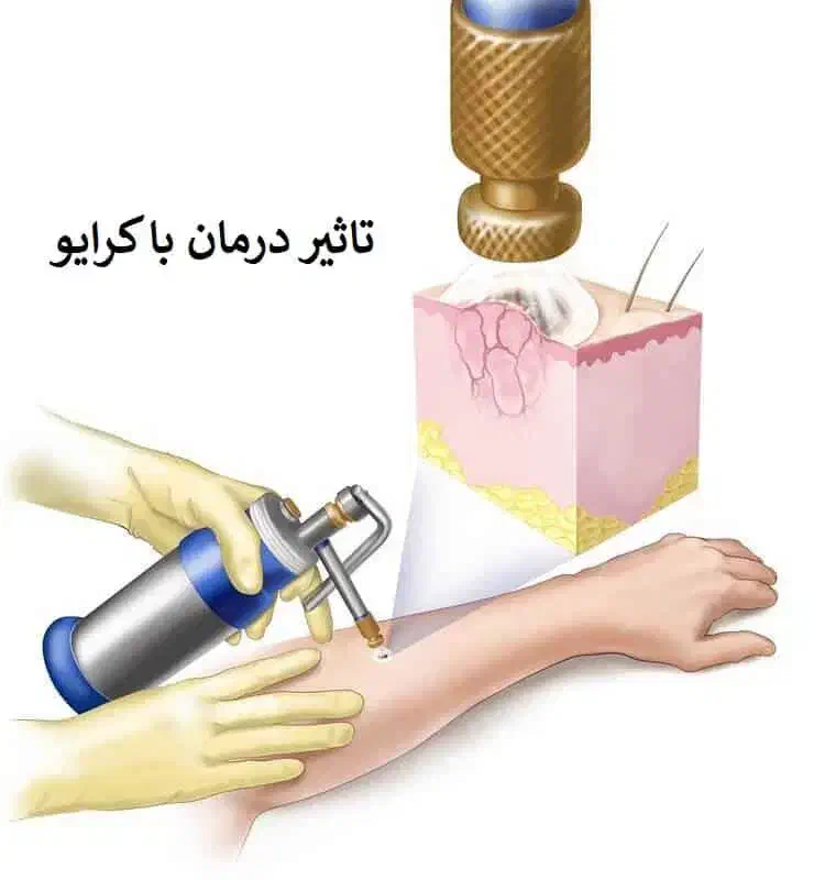 مرکز تخصصی(زگیل تناسلی کرایو فریز)میخچه وشت اضافی|خدمات آرایشگری و زیبایی|اهواز, گلستان|دیوار