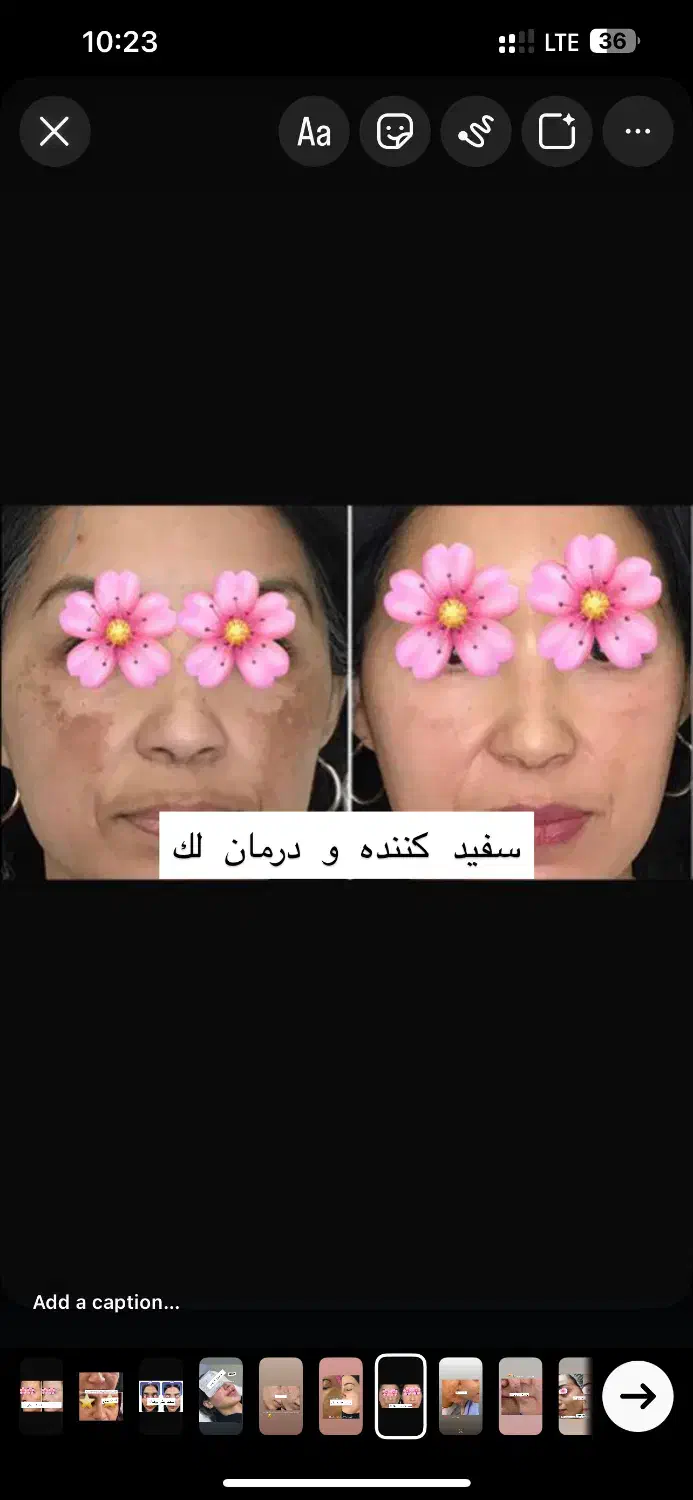 گلوتاتیون/درمان پیسی/روشن کننده کل صورت وبدن|خدمات آرایشگری و زیبایی|اهواز, کیانپارس |دیوار