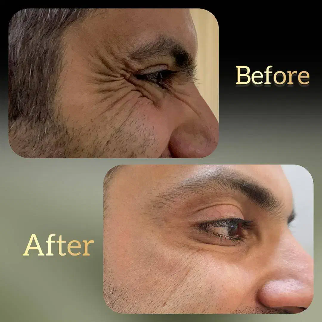 جشنواره بوتاکس پاییزه فقط تا پایان آبان ماه|خدمات آرایشگری و زیبایی|اصفهان, جلفا|دیوار