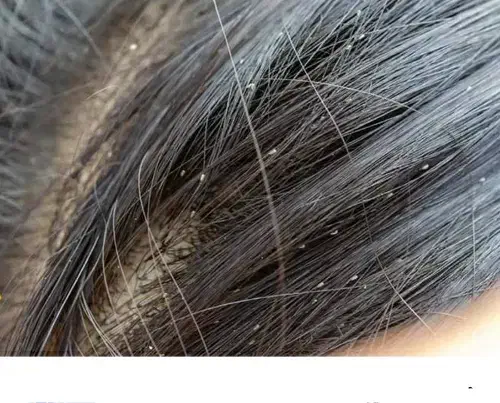 داروی صدرصد گیاهی رشکو و شپش|آرایشی، بهداشتی، درمانی|الوند, |دیوار