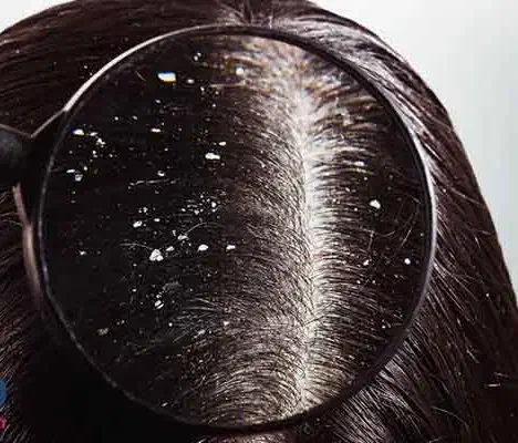 شامپو ضد شوره|لوازم حمام|اهواز, کیانپارس |دیوار