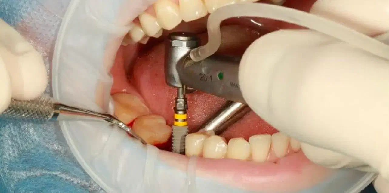 ایمپلنت با شرایط اقساطی به همراه کشیدن رایگان|خدمات آرایشگری و زیبایی|شیراز, خلیلی|دیوار