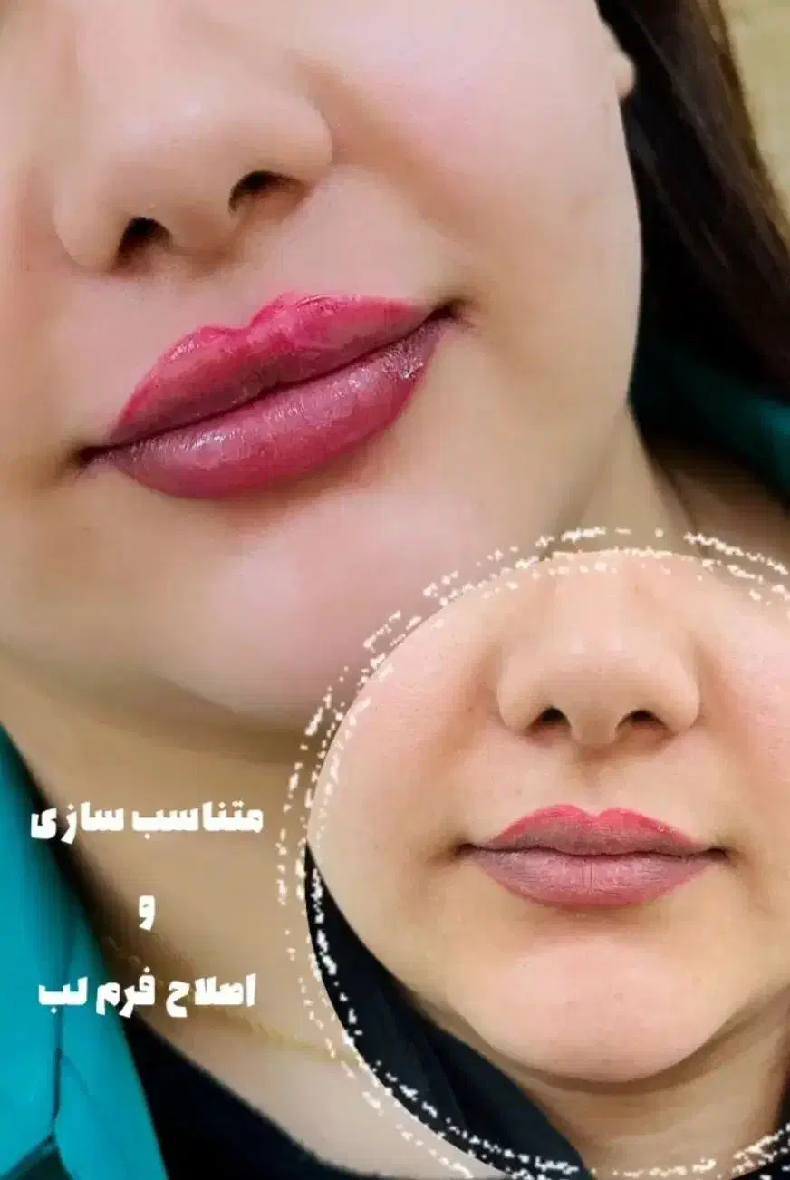 تزریق ژل بوتاکس فیشال توسط پزشک|خدمات آرایشگری و زیبایی|برازجان, |دیوار